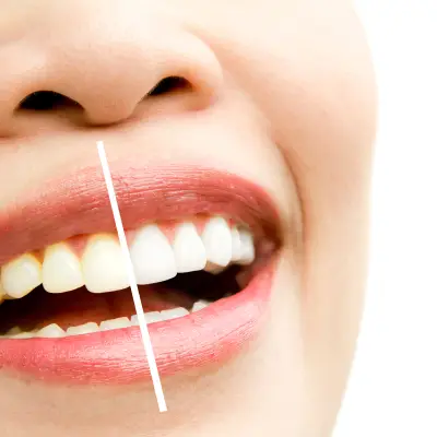 Clareamento Dental
