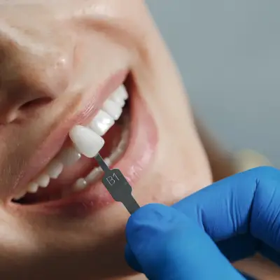 Implantes Dentários