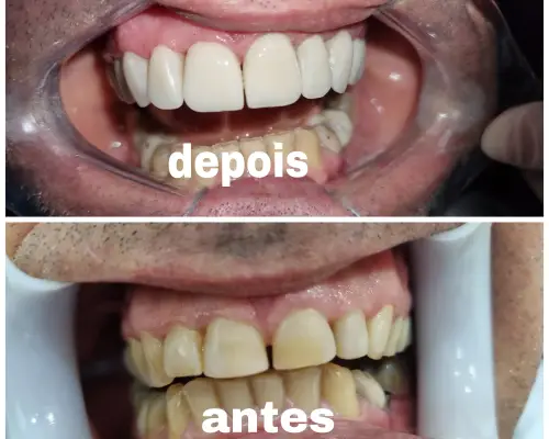 Antes e depois — Implante e Prótese