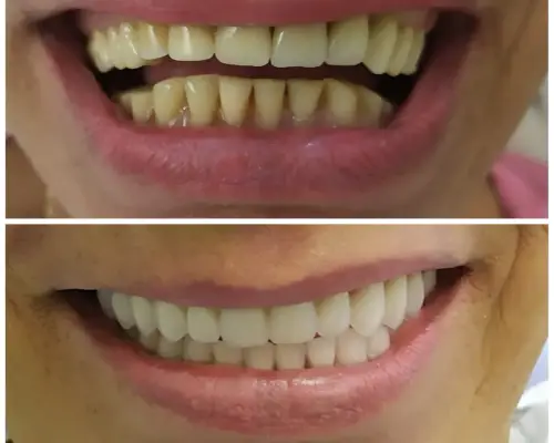 Antes e depois — Reabilitação Oral
