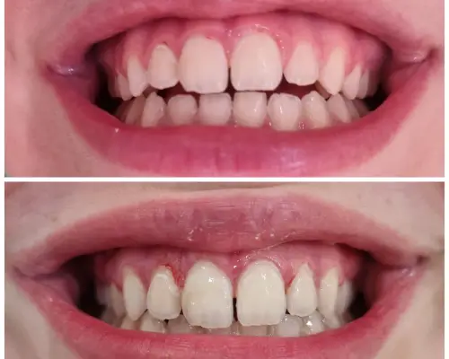 Antes e depois — Reabilitação Oral