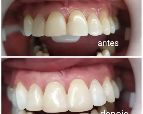 Antes e depois — Restauração Estética