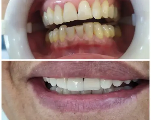 Antes e depois — Restauração Estética