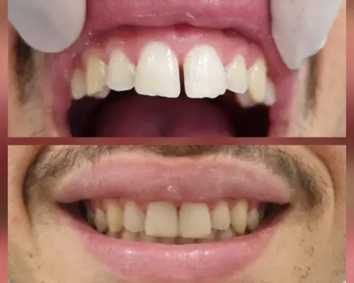 Antes e depois — Implante e Prótese