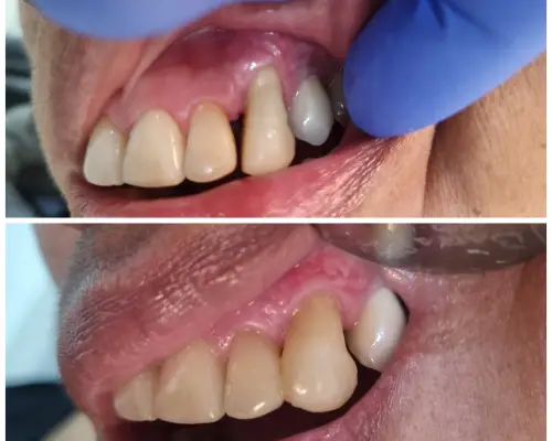 Antes e depois — Diastema